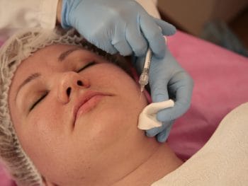 Preventative Botox