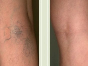 Spider Veins