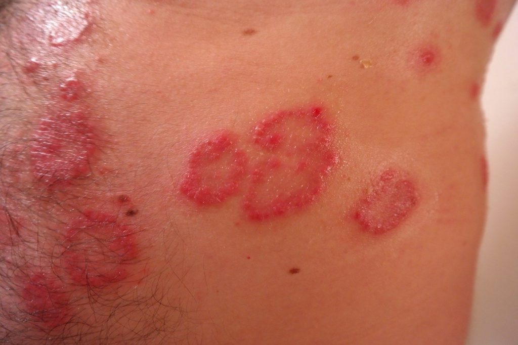 Enflamed Skin? Rash? It May be Eczema. Or Dermatitis
