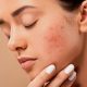 Say Goodbye to Acne Scars – For Good (Part 1)
