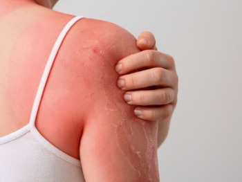 What a Peeling Sunburn Really Means