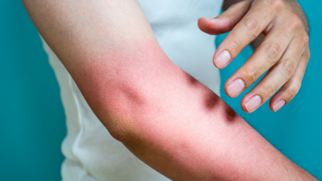 The Dos and Don’ts of Treating a Sunburn