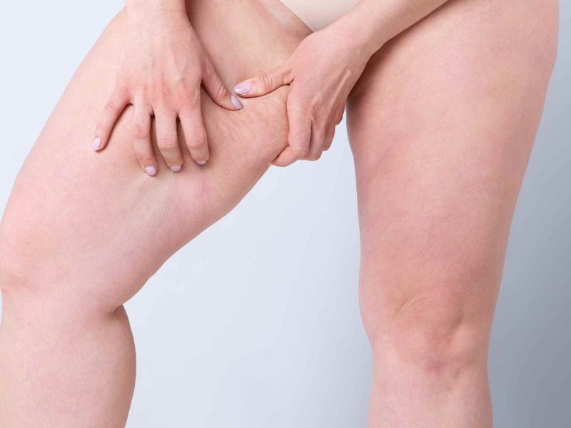 A Summer Without Chafed Thighs? This Is How You Can Make It Happen