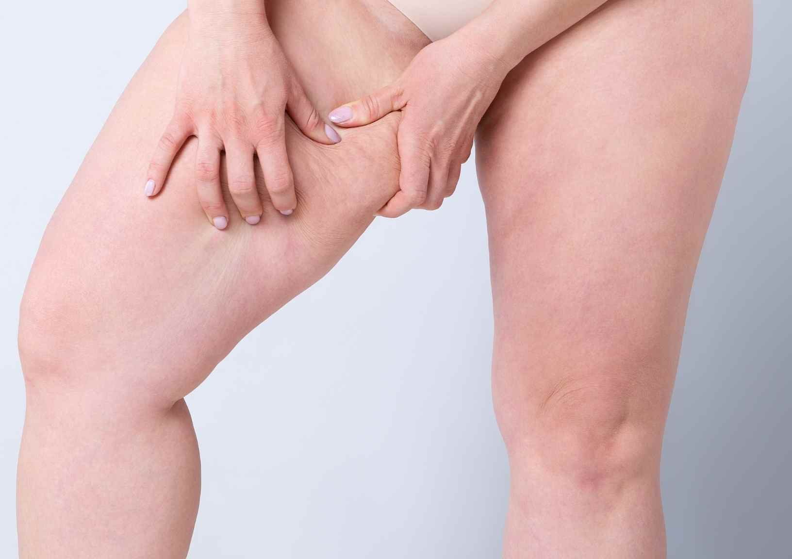 A Summer Without Chafed Thighs? This Is How You Can Make It Happen - Center  For Dermatology & Laser Skin Surgery